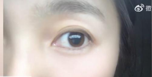 女子左眼瞳孔变大2倍找不到病因